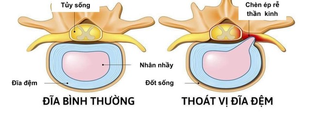  Những người hay kêu đau lưng, coi chừng thoát vị đĩa đệm 