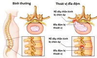  Những người hay kêu đau lưng, coi chừng thoát vị đĩa đệm 